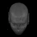 CT scan