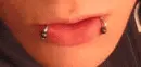 Snakebites