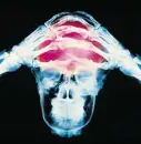 Head X-Ray