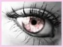 pink eye
