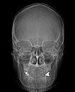 skull