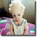 albino