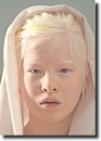 albino people