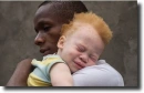 albino people