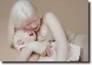 albino people