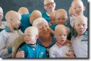 albino people