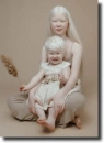 albino people