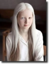 albino people