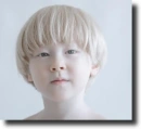 albino people