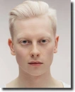 albino people
