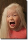 albino people