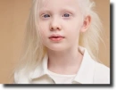 albino people