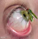 Bug on eye