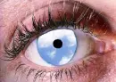 cloudy eye
